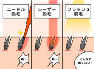 ヒゲ脱毛の施術種類と内容