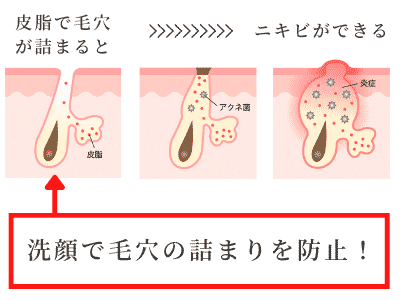 ニキビ ケア 原因