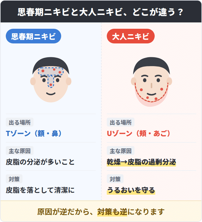 思春期ニキビと大人ニキビのできる部位と原因の違いを比較した図